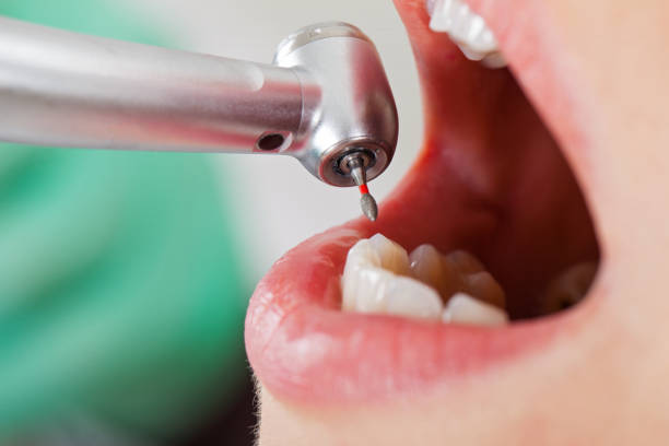 Best Emergency Broken Tooth Repair in Mccla, AL